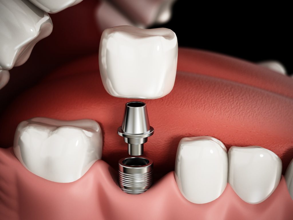 3D rendering representing the structure of dental implant procedure