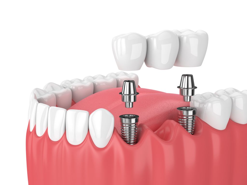 3d render of jaw and implants with dental bridge