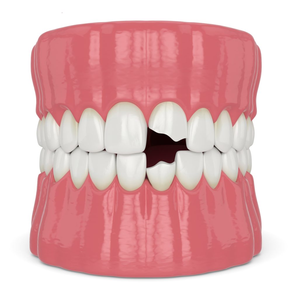 3d render of jaw with broken incisors teeth