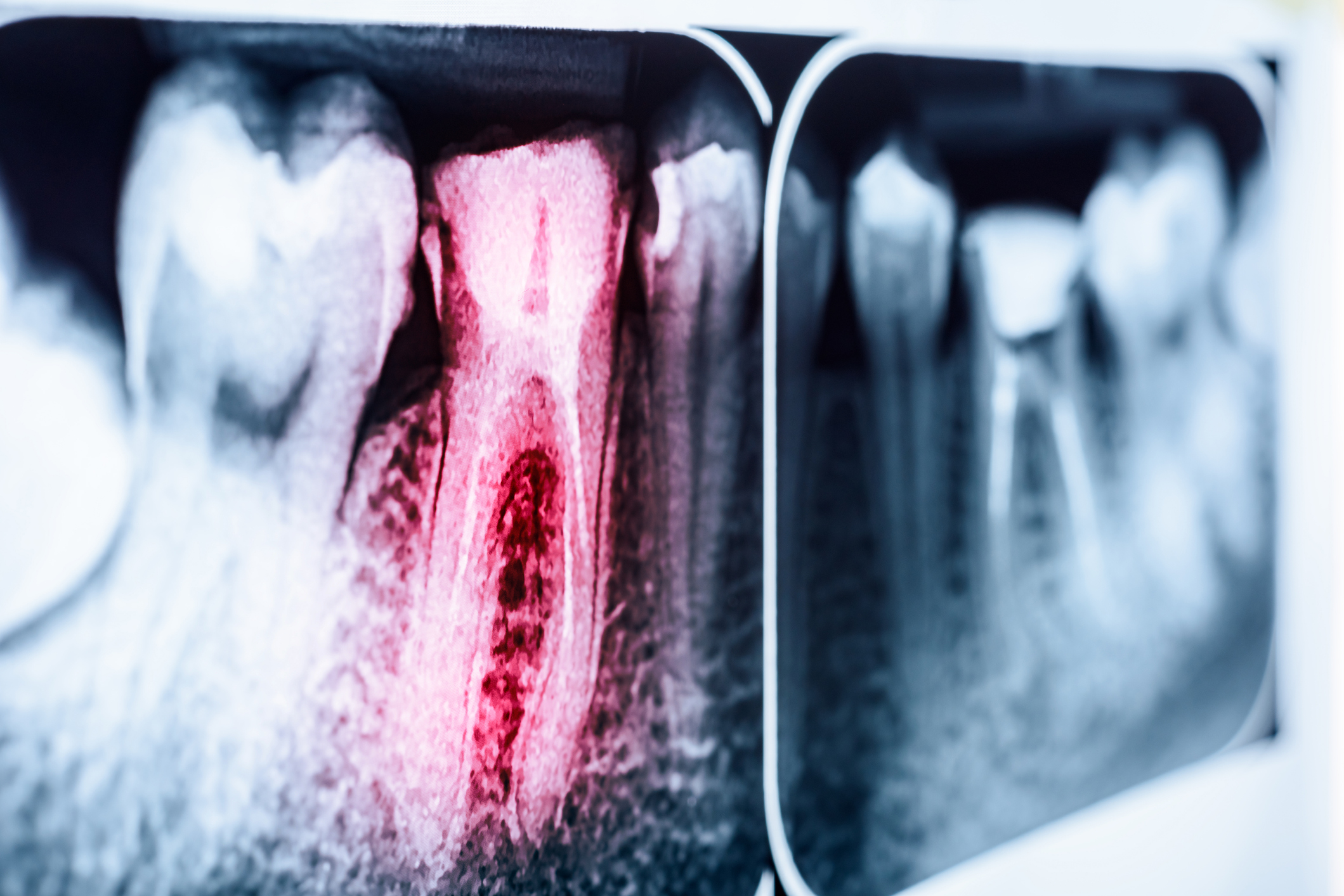 Pain Of Tooth Decay On X-Ray
